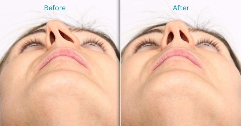 septoplasty before and after surgery in bangalore